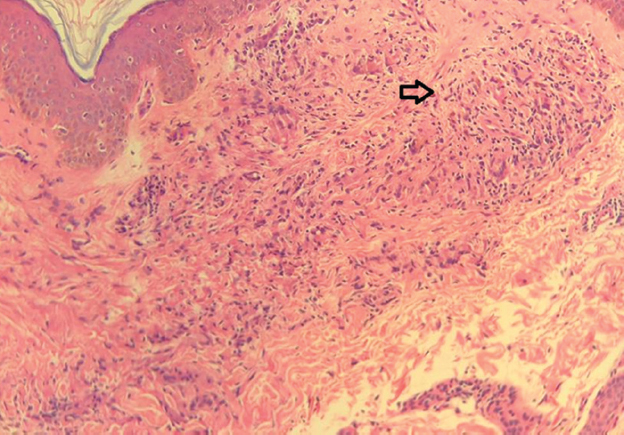 Histopathology image: Skin biopsy, from papulopustular lesion over the upper back. Image showing ill-to-well-formed granulomas (hollow arrow) with giant cells, interstitial giant cells and histiocytes in the upper dermis (H and E, ×10).